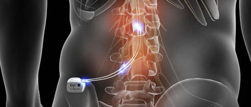 spinalcordstimulators